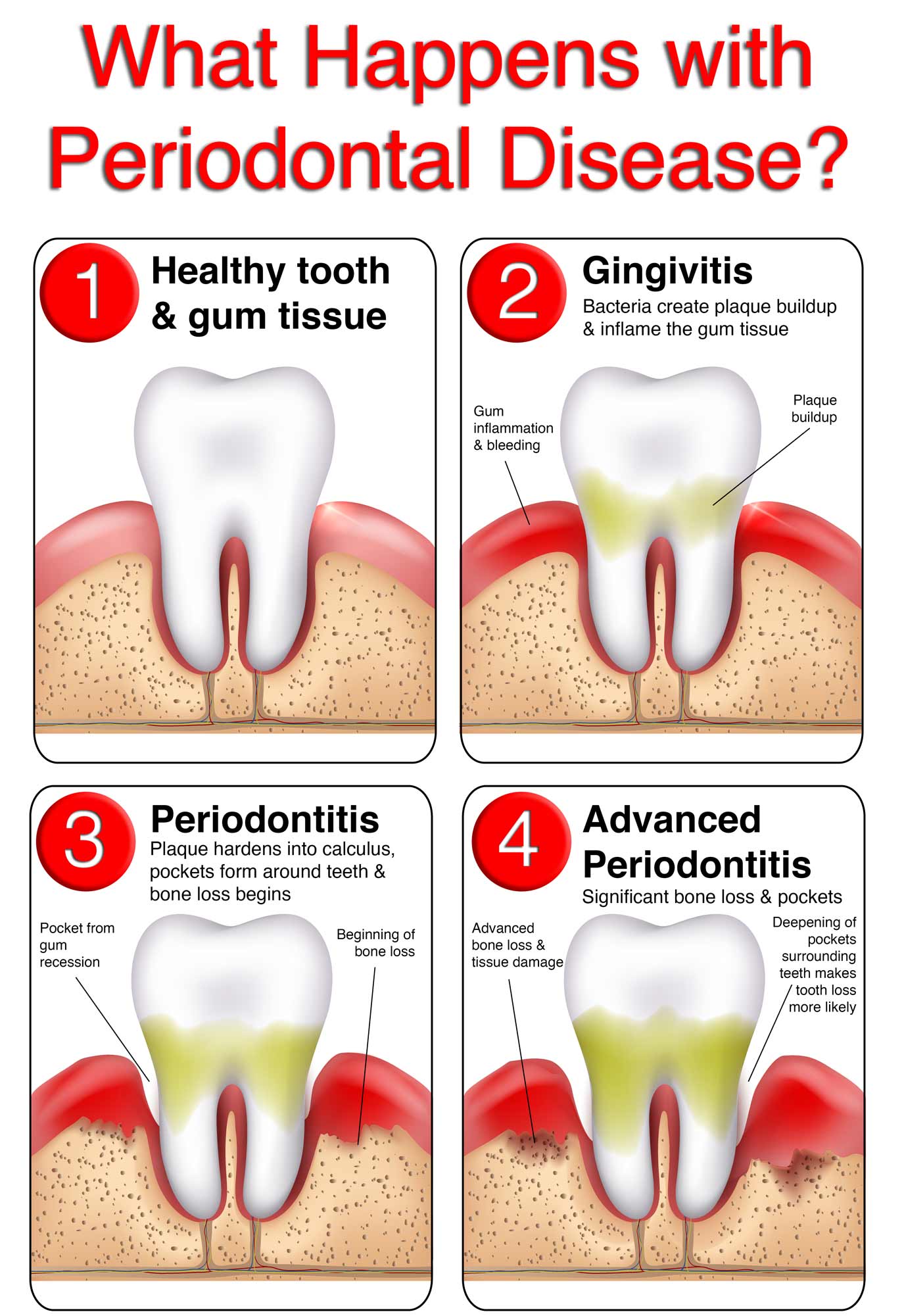 periodontitis chart web