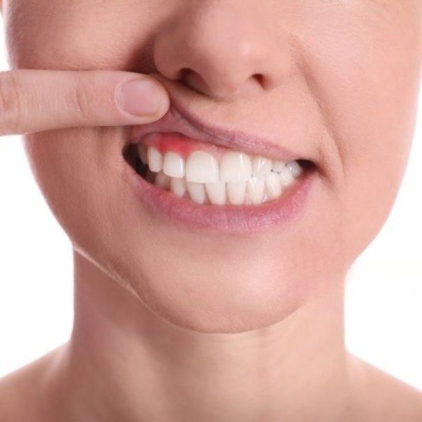 download (1) (1) gum disease treatment